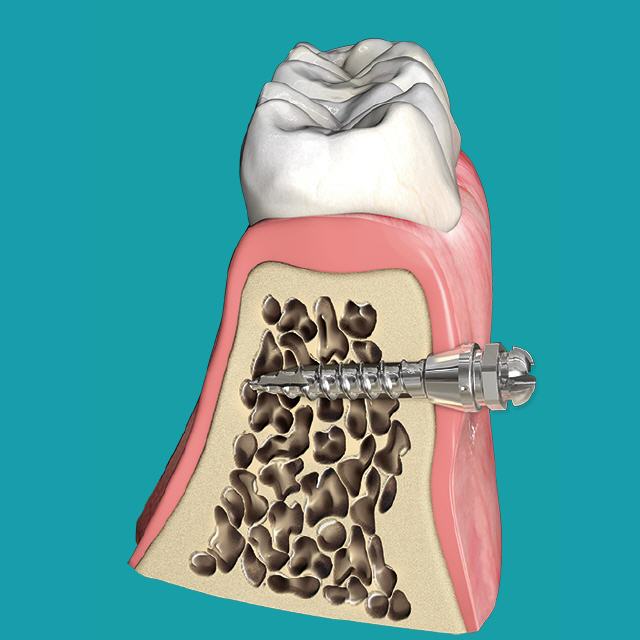 Modellzeichnung eines Mini-Implantats